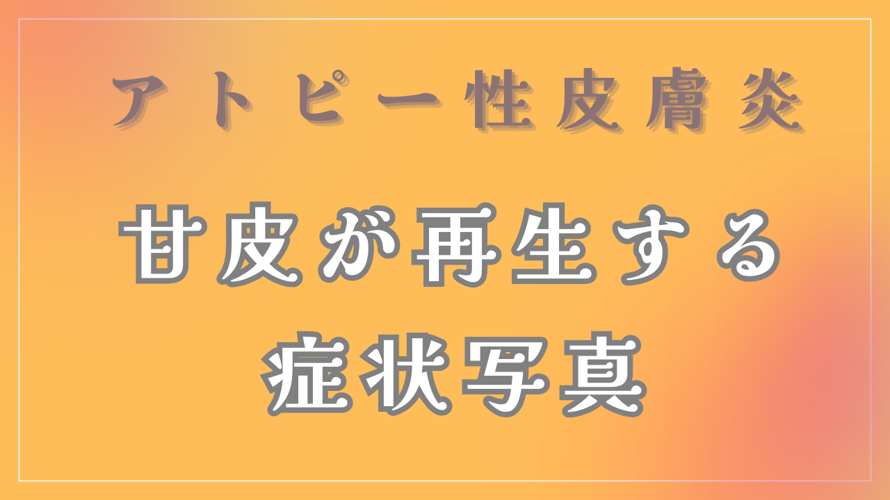 アトピーと甘皮について