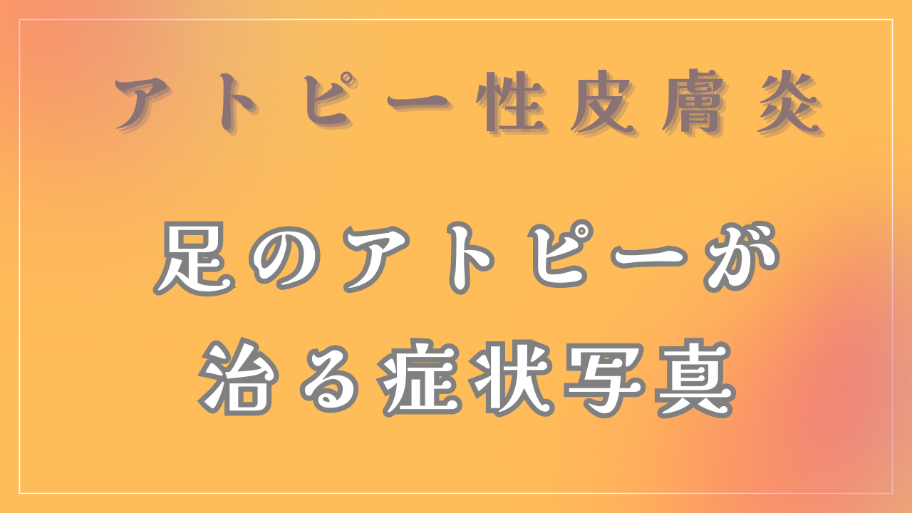 足のアトピーの症状写真