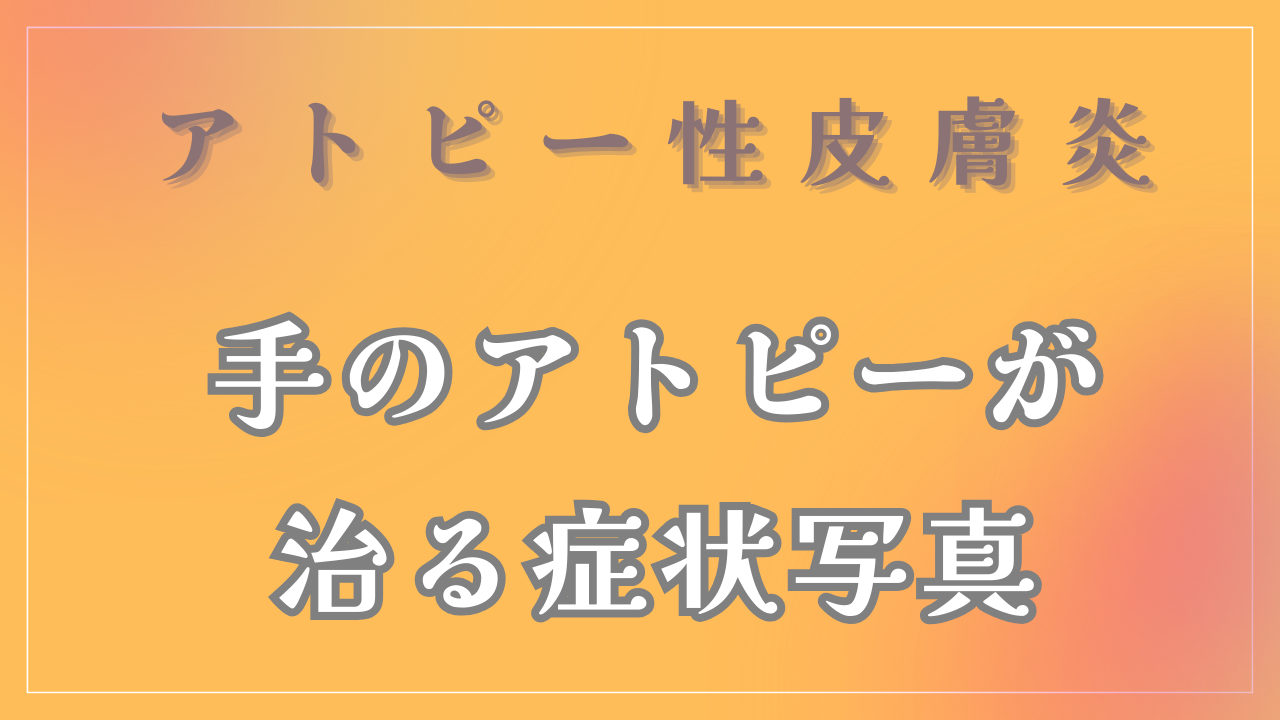 手のアトピーの症状写真