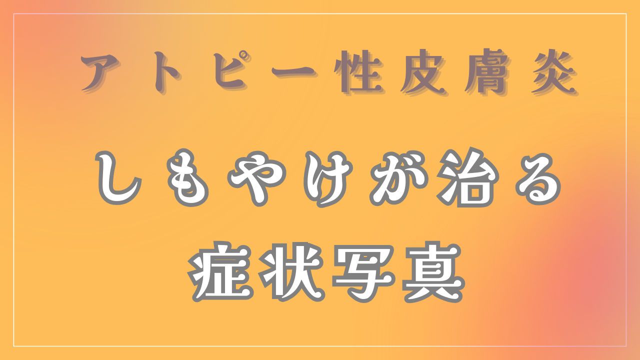 アトピーとしもやけの症状写真