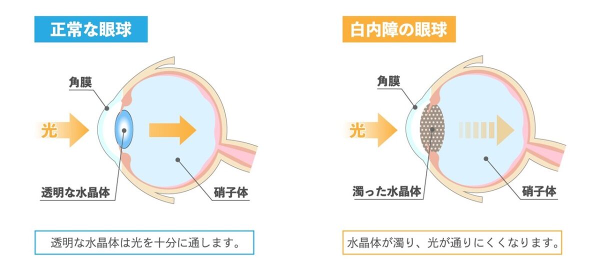 白内障